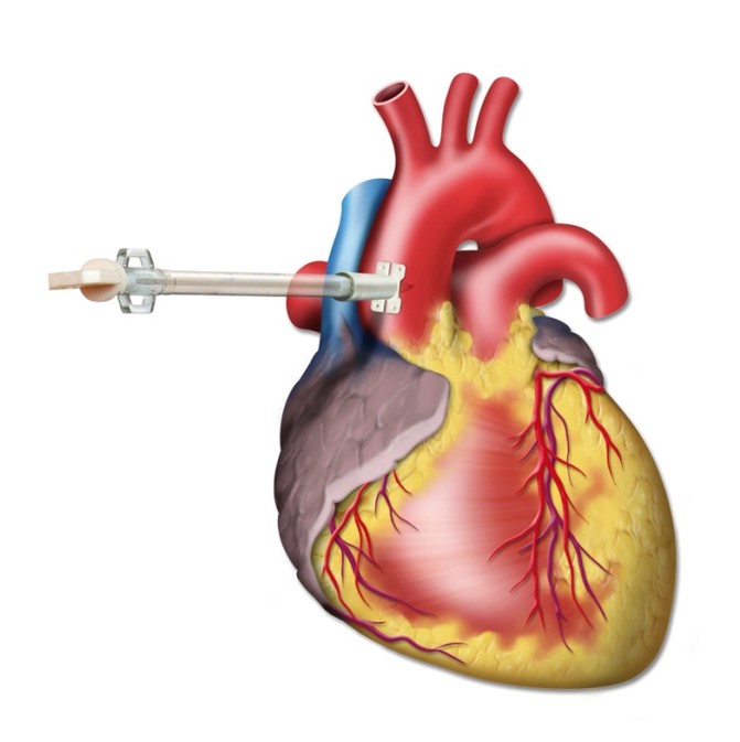 картинка Артериальные  канюли